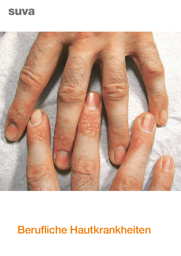 Berufliche Hautkrankheiten